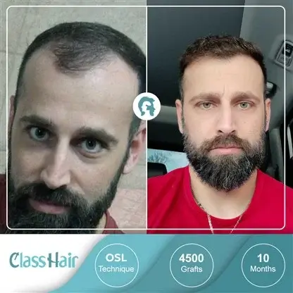 Which technique is the most suitable for painless hair transplantation?