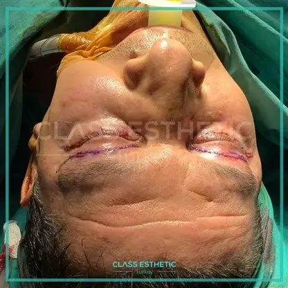 Neck Lift in Istanbul