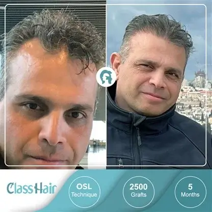 Le Meilleur Centre de Greffe de Cheveux en Turquie