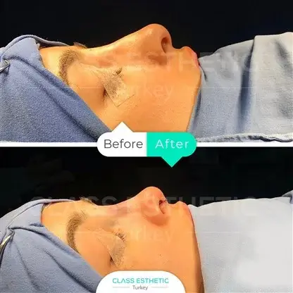 What is Forehead Lift Surgery?